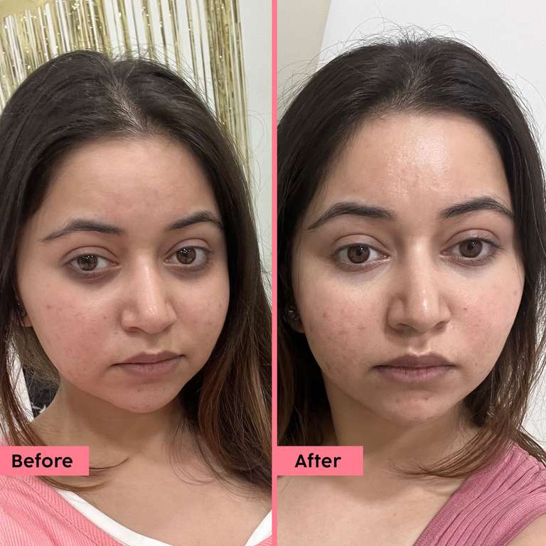 Plix Watermelon Hydrogel Under Eye Patches for Dark Circles & Puffiness With Caffeine, 60 Patches